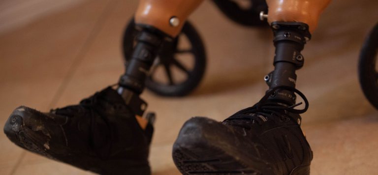 Doctors and Health Care Giants Exploit Those Who Lost Their Legs